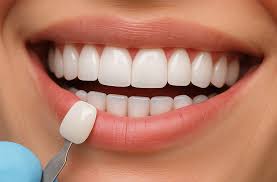 Veneers Cost Guide: What You’ll Pay Per Tooth for a New Smile