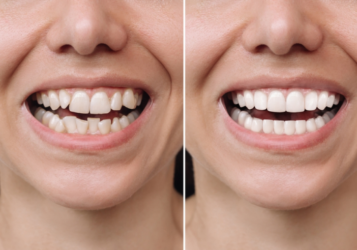Thinking About Invisalign Middlesbrough? Start With These Practical Facts Invisalign Middlesbrough
